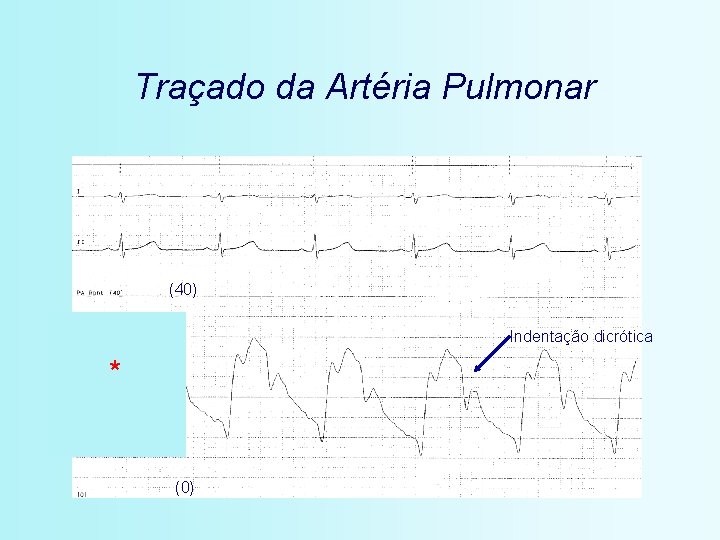 Traçado da Artéria Pulmonar (40) Indentação dicrótica * (0) 