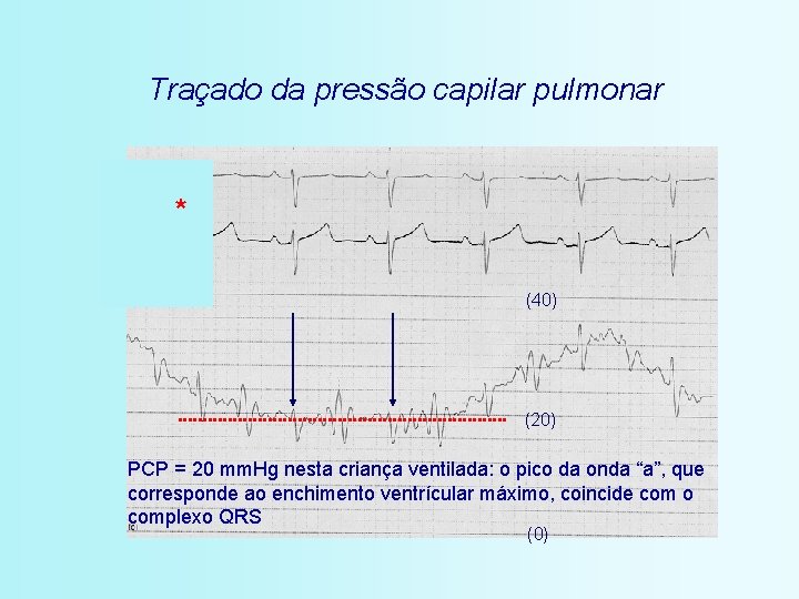 Traçado da pressão capilar pulmonar * (40) (20) PCP = 20 mm. Hg nesta