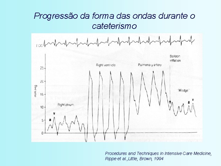 Progressão da forma das ondas durante o cateterismo Procedures and Techniques in Intensive Care