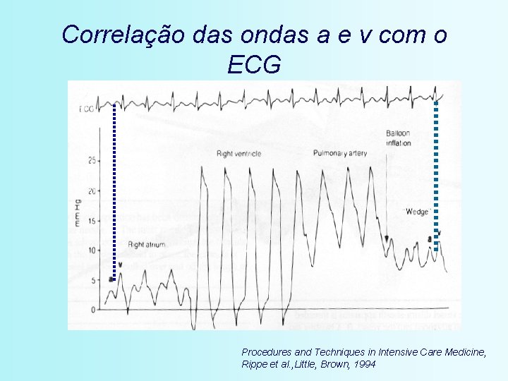 Correlação das ondas a e v com o ECG Procedures and Techniques in Intensive