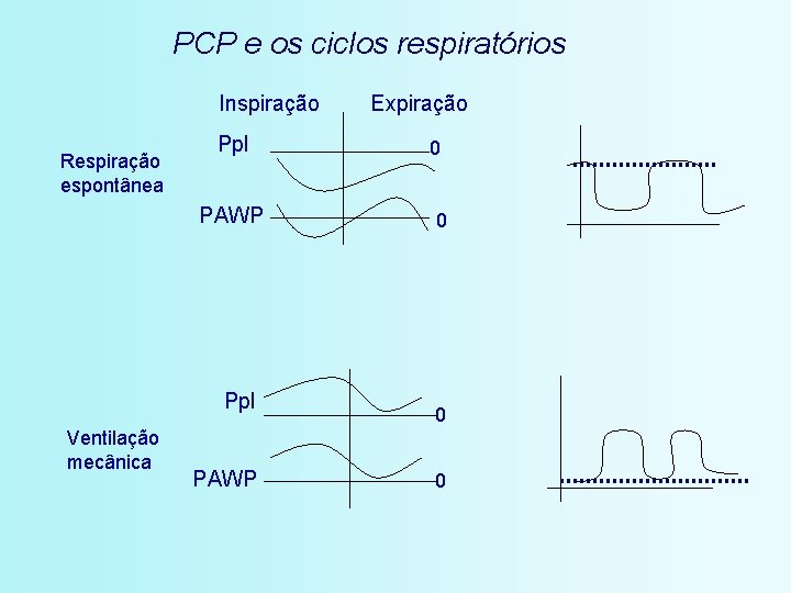 PCP e os ciclos respiratórios Inspiração Respiração espontânea Ppl PAWP Ppl Ventilação mecânica PAWP