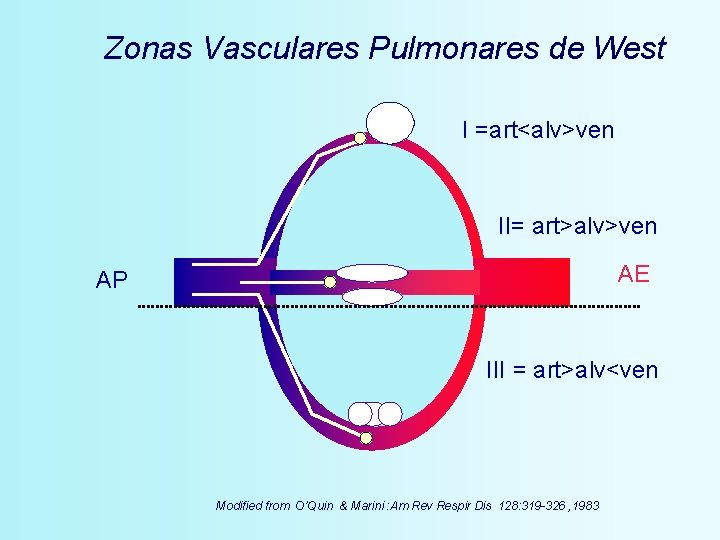 Zonas Vasculares Pulmonares de West I =art<alv>ven II= art>alv>ven AE AP III = art>alv<ven