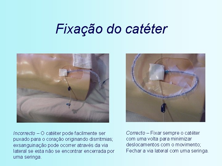 Fixação do catéter Incorrecto – O catéter pode facilmente ser puxado para o coração