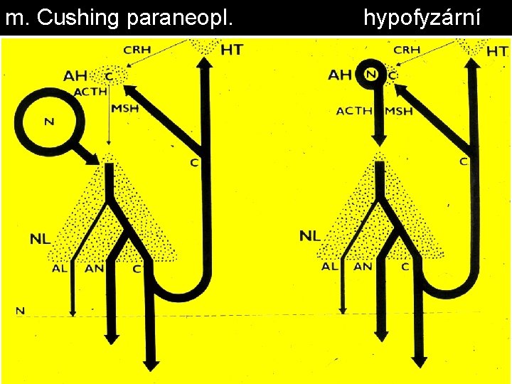 m. Cushing paraneopl. hypofyzární 