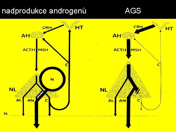nadprodukce androgenů AGS 