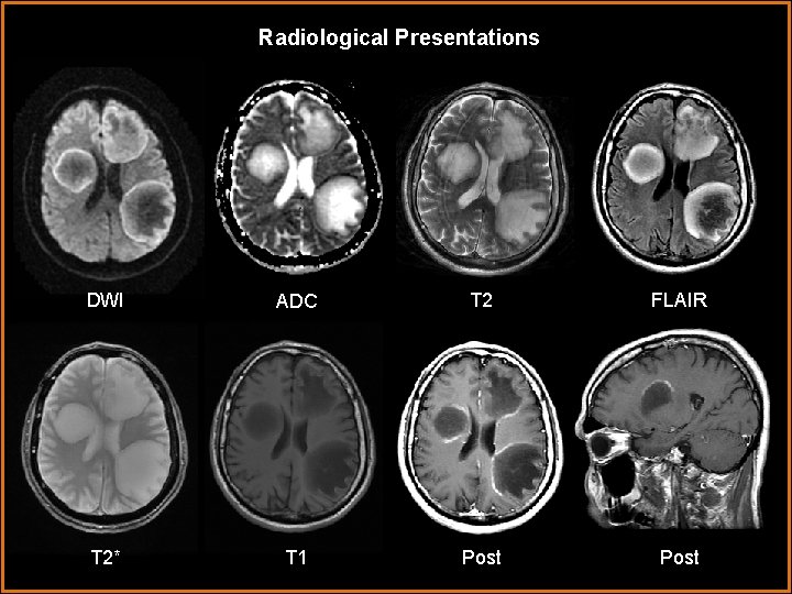 Radiological Presentations DWI ADC T 2 FLAIR T 2* T 1 Post 