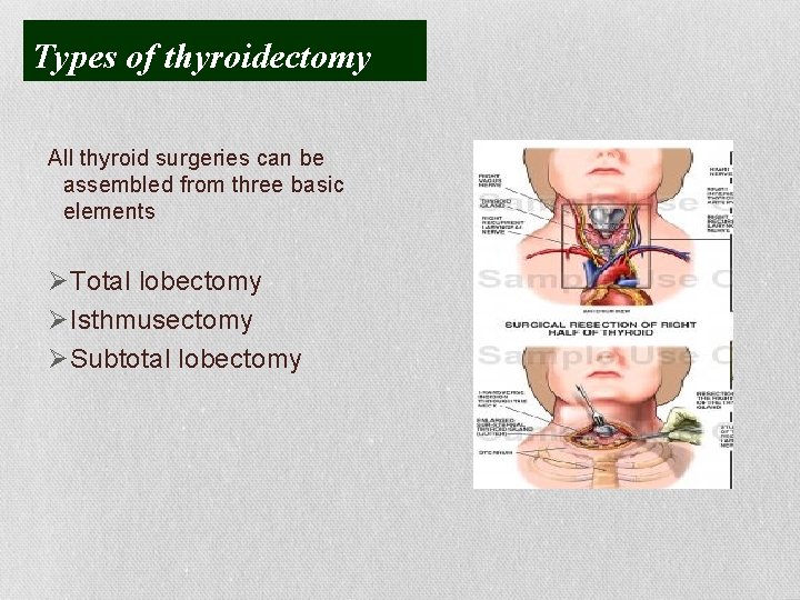 Types of thyroidectomy All thyroid surgeries can be assembled from three basic elements ØTotal