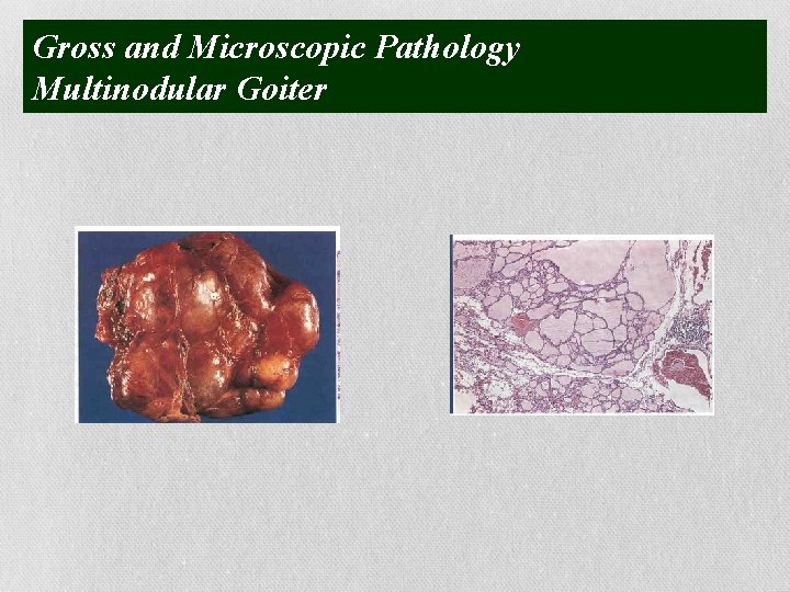 Gross and Microscopic Pathology Multinodular Goiter 