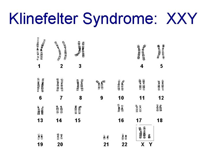 Klinefelter Syndrome: XXY Klinefelter Syndrome: XXY