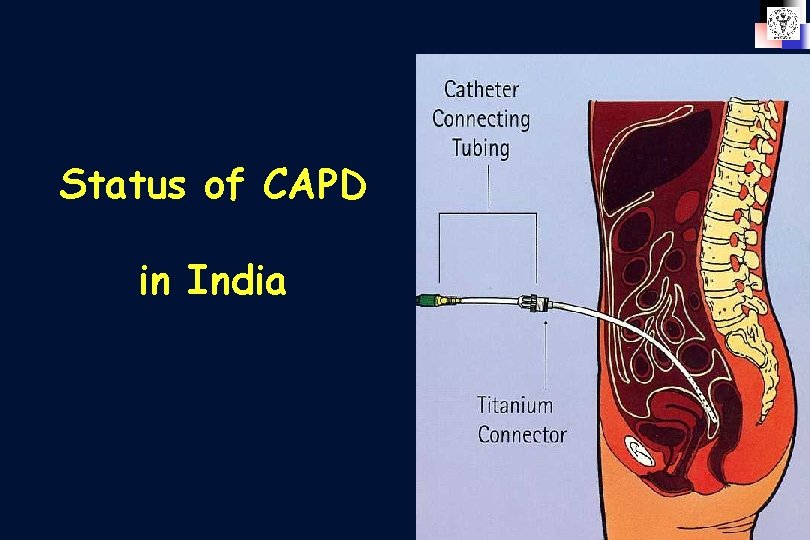 Status of CAPD in India 