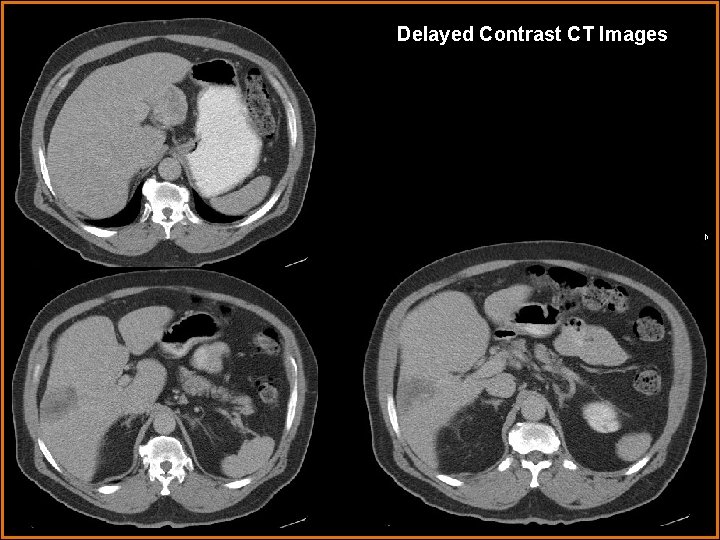 Delayed Contrast CT Images 