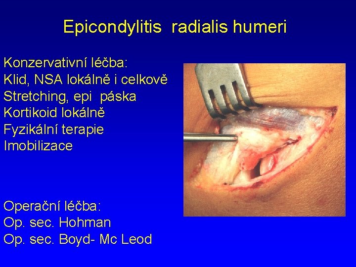 Epicondylitis radialis humeri Konzervativní léčba: Klid, NSA lokálně i celkově Stretching, epi páska Kortikoid