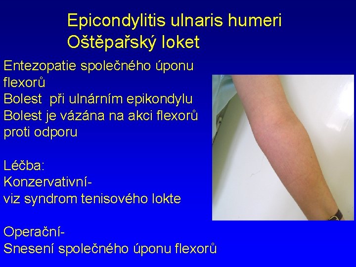 Epicondylitis ulnaris humeri Oštěpařský loket Entezopatie společného úponu flexorů Bolest při ulnárním epikondylu Bolest