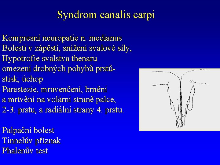 Syndrom canalis carpi Kompresní neuropatie n. medianus Bolesti v zápěstí, snížení svalové síly, Hypotrofie