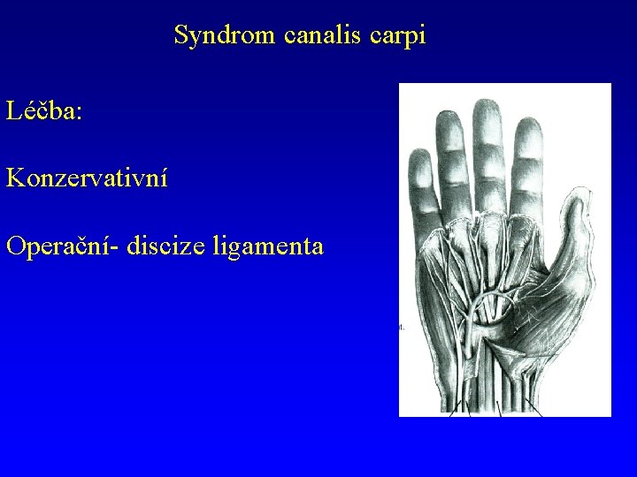 Syndrom canalis carpi Léčba: Konzervativní Operační- discize ligamenta 