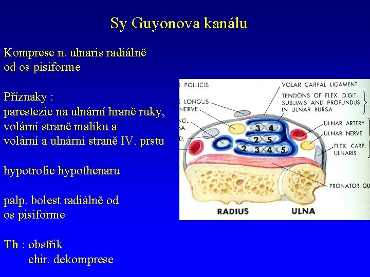 Sy Guyonova kanálu Komprese n. ulnaris radiálně od os pisiforme Příznaky : parestezie na