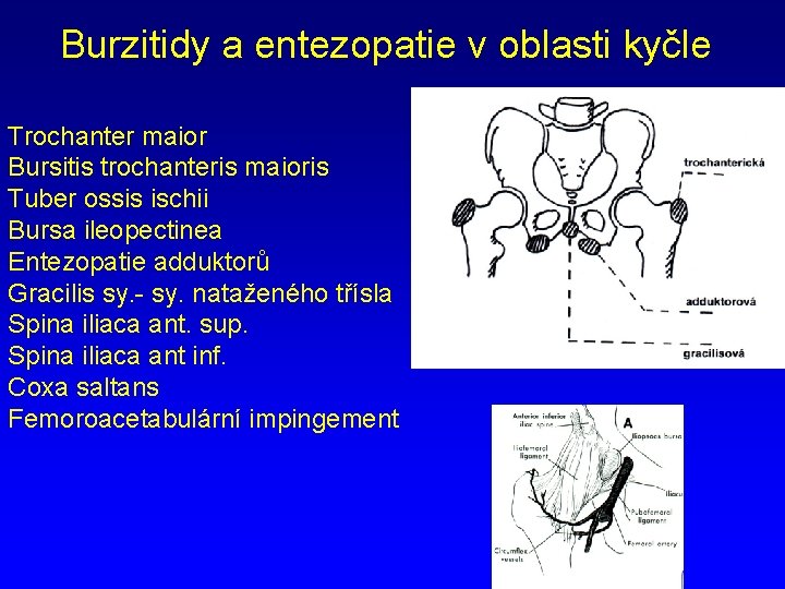Burzitidy a entezopatie v oblasti kyčle Trochanter maior Bursitis trochanteris maioris Tuber ossis ischii