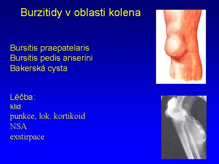 Burzitidy v oblasti kolena Bursitis praepatelaris Bursitis pedis anserini Bakerská cysta Léčba: klid punkce,