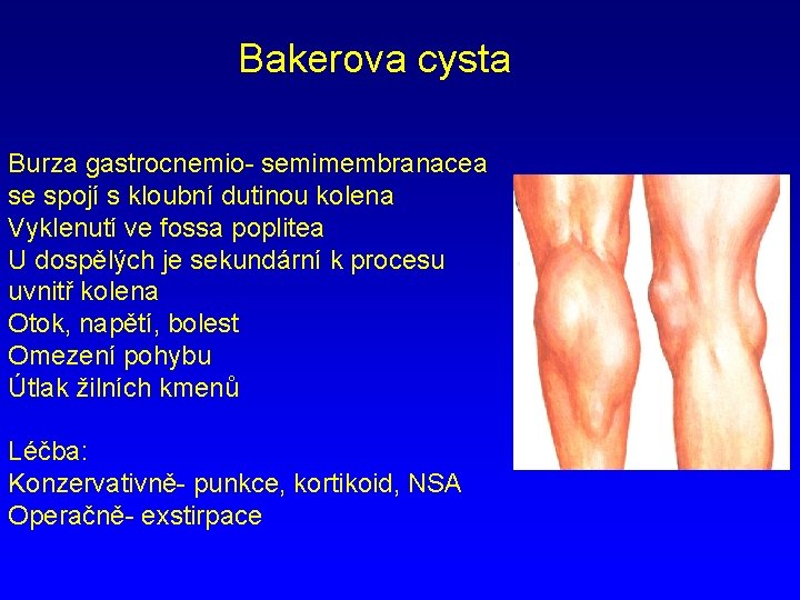 Bakerova cysta Burza gastrocnemio- semimembranacea se spojí s kloubní dutinou kolena Vyklenutí ve fossa