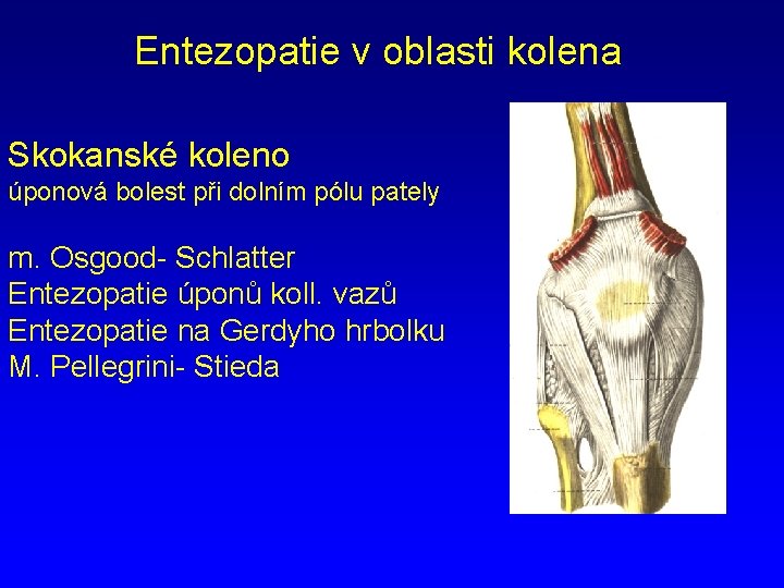 Entezopatie v oblasti kolena Skokanské koleno úponová bolest při dolním pólu pately m. Osgood-