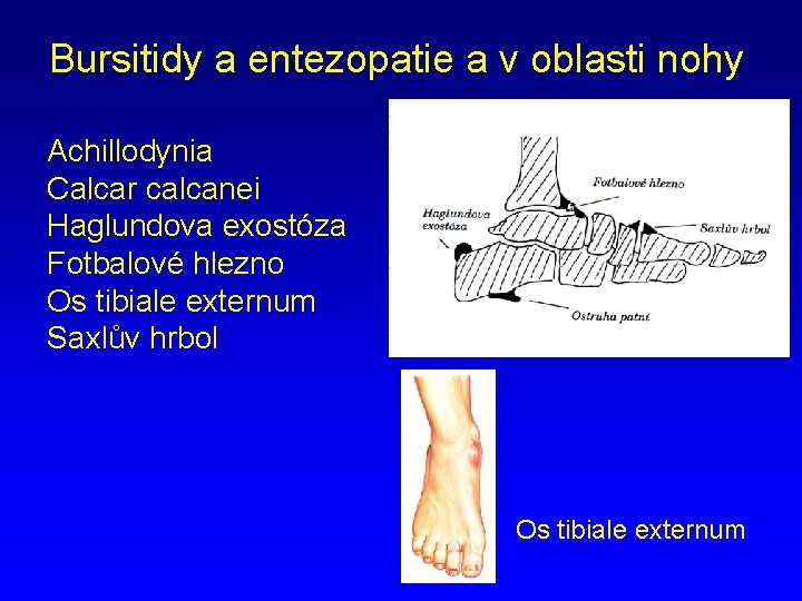 Bursitidy a entezopatie a v oblasti nohy Achillodynia Calcar calcanei Haglundova exostóza Fotbalové hlezno