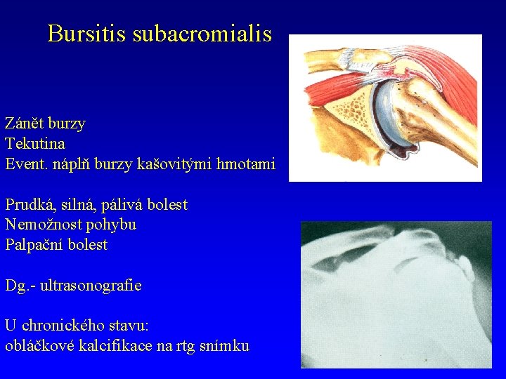 Bursitis subacromialis Zánět burzy Tekutina Event. náplň burzy kašovitými hmotami Prudká, silná, pálivá bolest