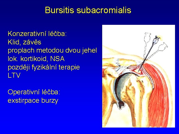Bursitis subacromialis Konzerativní léčba: Klid, závěs proplach metodou dvou jehel lok. kortikoid, NSA později