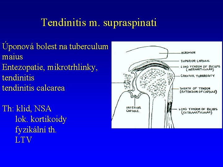 Tendinitis m. supraspinati Úponová bolest na tuberculum maius Entezopatie, mikrotrhlinky, tendinitis calcarea Th: klid,
