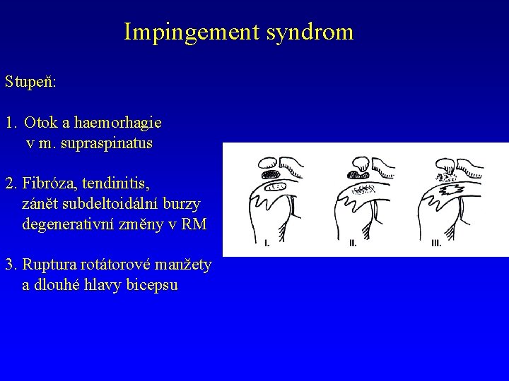 Impingement syndrom Stupeň: 1. Otok a haemorhagie v m. supraspinatus 2. Fibróza, tendinitis, zánět