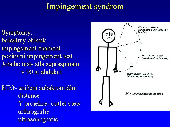 Impingement syndrom Symptomy: bolestivý oblouk impingement znamení pozitivní impingement test Jobeho test- síla supraspinatu
