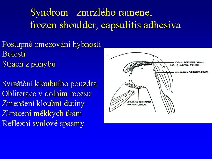 Syndrom zmrzlého ramene, frozen shoulder, capsulitis adhesiva Postupné omezování hybnosti Bolesti Strach z pohybu