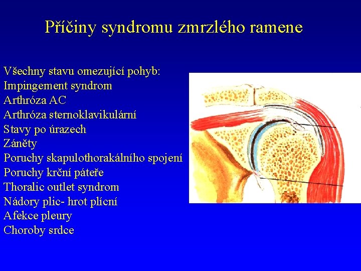 Příčiny syndromu zmrzlého ramene Všechny stavu omezující pohyb: Impingement syndrom Arthróza AC Arthróza sternoklavikulární