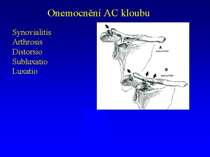 Onemocnění AC kloubu Synovialitis Arthrosis Distorsio Subluxatio Luxatio 
