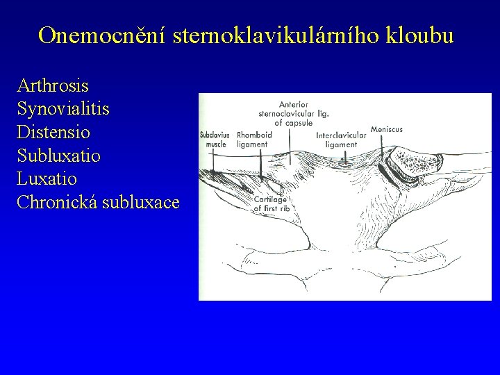 Onemocnění sternoklavikulárního kloubu Arthrosis Synovialitis Distensio Subluxatio Luxatio Chronická subluxace 