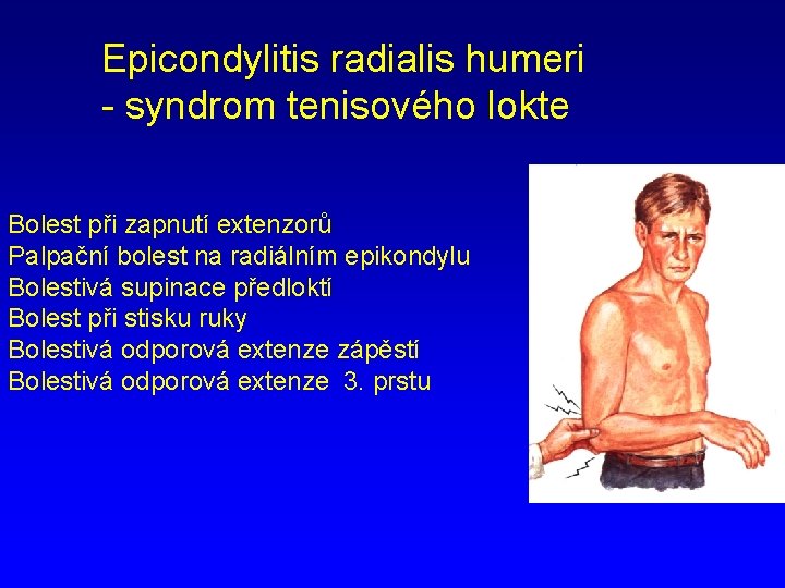 Epicondylitis radialis humeri - syndrom tenisového lokte Bolest při zapnutí extenzorů Palpační bolest na