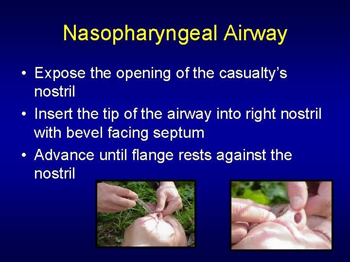 Nasopharyngeal Airway • Expose the opening of the casualty’s nostril • Insert the tip