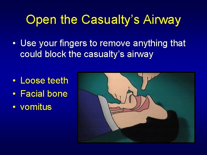 Open the Casualty’s Airway • Use your fingers to remove anything that could block