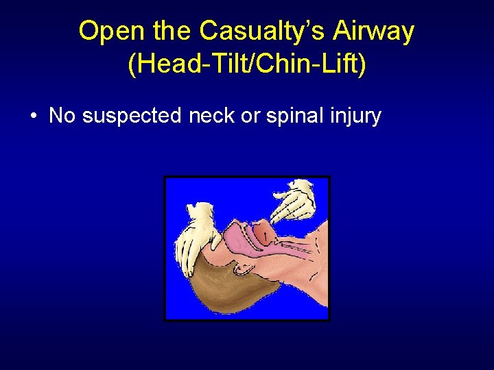 Open the Casualty’s Airway (Head-Tilt/Chin-Lift) • No suspected neck or spinal injury 