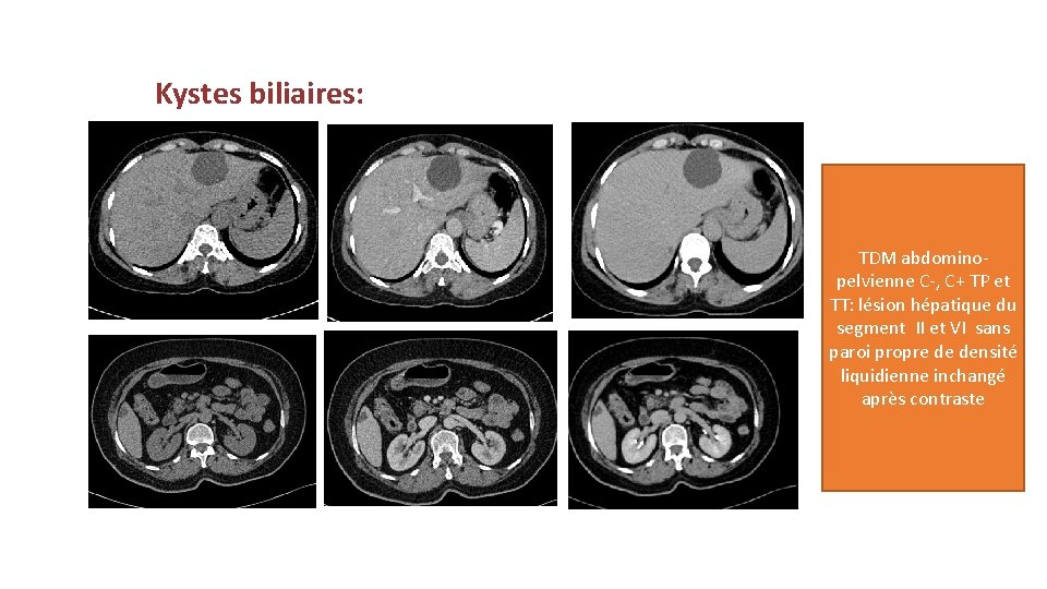 Kystes biliaires: TDM abdominopelvienne C-, C+ TP et TT: lésion hépatique du segment II