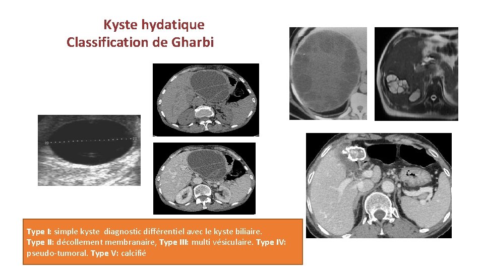  Kyste hydatique Classification de Gharbi IRM hépatique : deux kystes hydatiques du segment