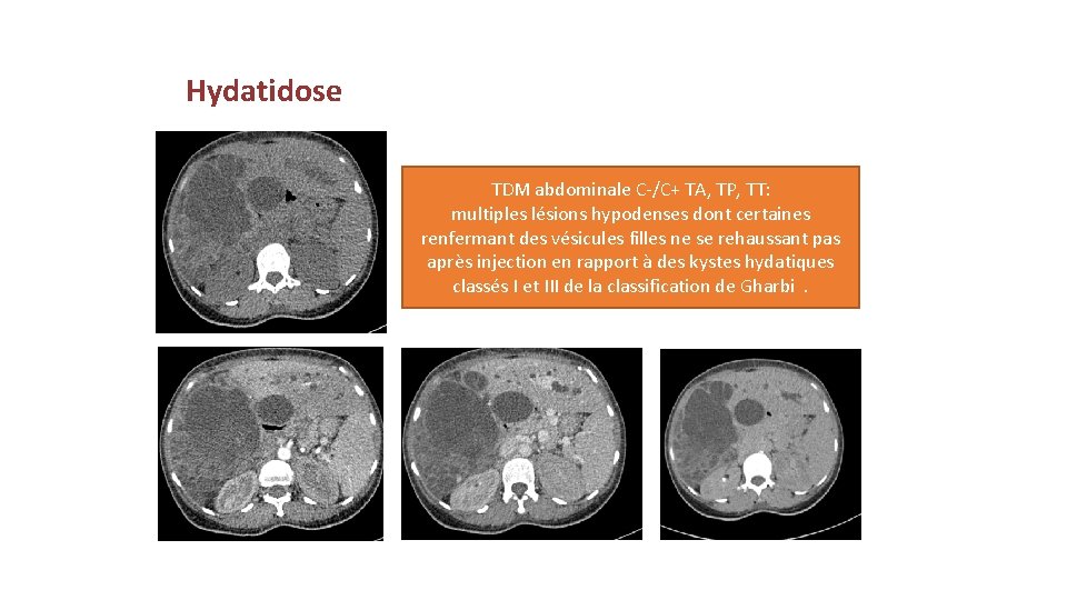  Hydatidose TDM abdominale C-/C+ TA, TP, TT: multiples lésions hypodenses dont certaines renfermant