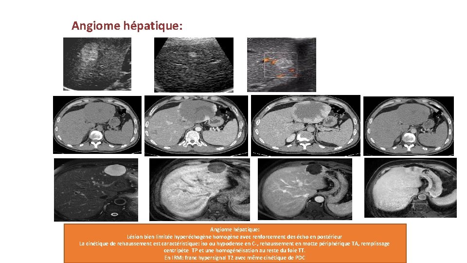 Angiome hépatique: Lésion bien limitée hyperéchogène homogène avec renforcement des écho en postérieur La
