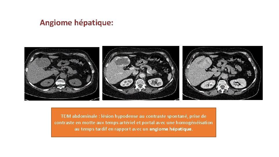 Angiome hépatique: TDM abdominale : lésion hypodense au contraste spontané, prise de contraste en