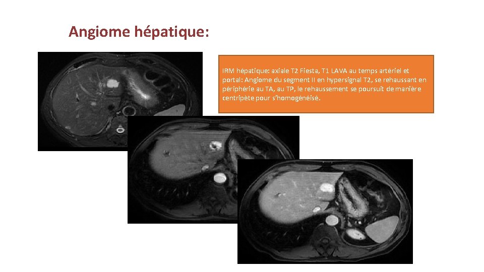 Angiome hépatique: IRM hépatique: axiale T 2 Fiesta, T 1 LAVA au temps artériel