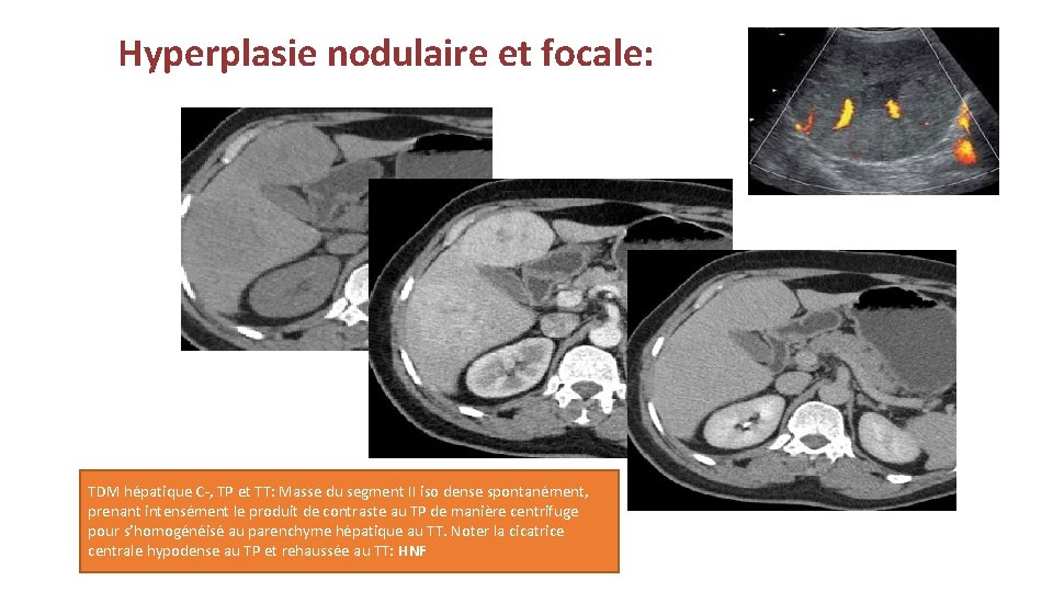 Hyperplasie nodulaire et focale: TDM hépatique C-, TP et TT: Masse du segment II