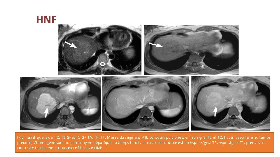 HNF IRM hépatique: axial T 2, T 1 G- et T 1 G+ TA,