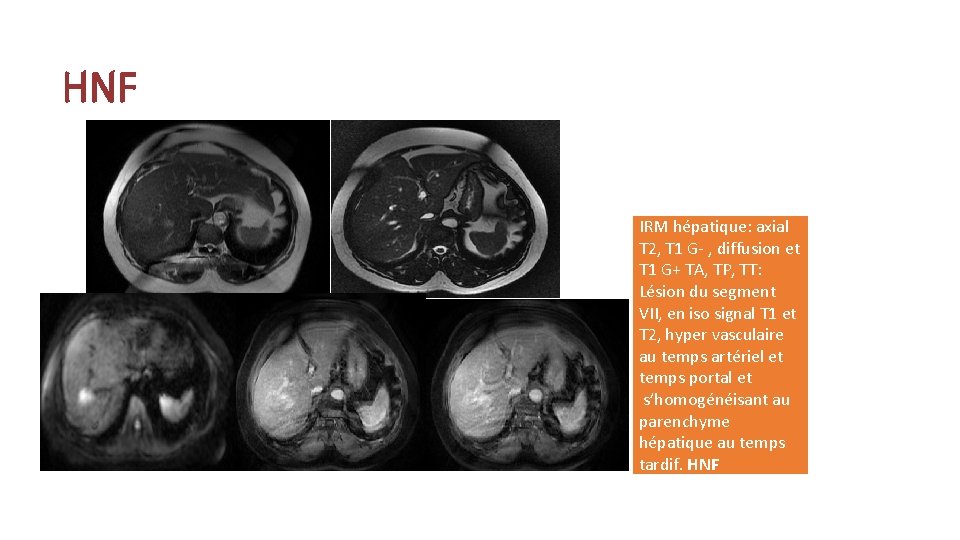 HNF IRM hépatique: axial T 2, T 1 G- , diffusion et T 1