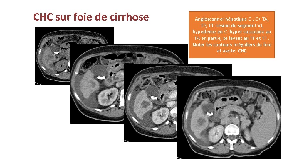 CHC sur foie de cirrhose Angioscanner hépatique C-, C+ TA, TP, TT: Lésion du