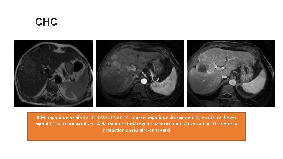 CHC IRM hépatique axiale T 2, T 1 LAVA TA et TP: masse hépatique