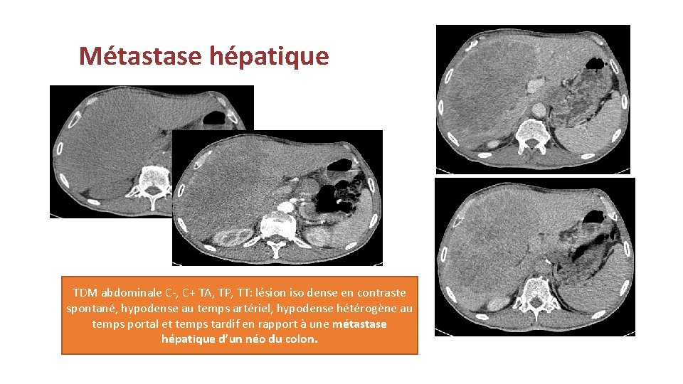 Métastase hépatique TDM abdominale C-, C+ TA, TP, TT: lésion iso dense en contraste